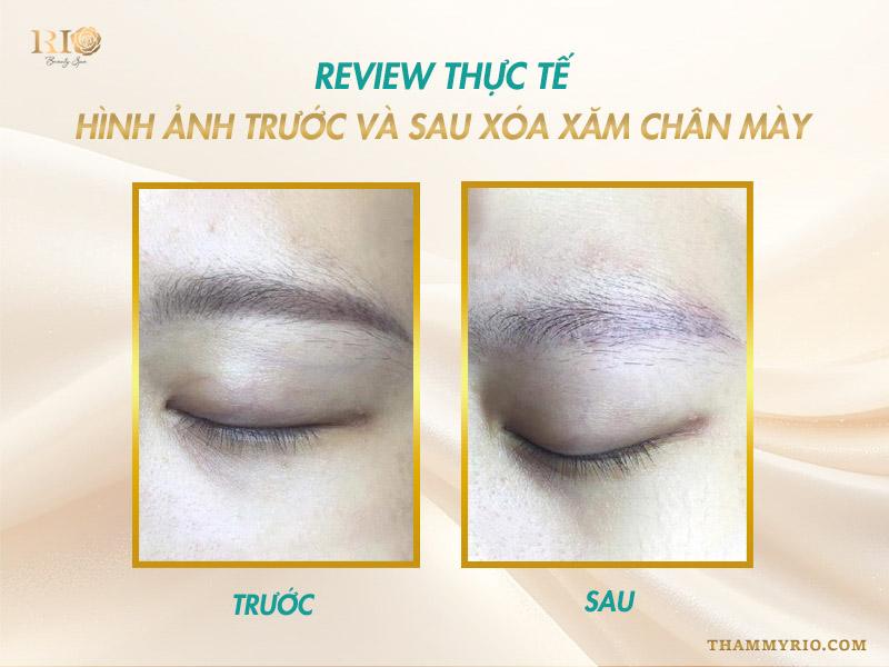 Xóa xăm uy tín: Những tiêu chí xóa xăm mới nhất 2025 11 Thẩm mỹ rio là địa chỉ xoá xăm uy tín với những ca xóa xăm mày sạch sẽ hoàn toàn và không sẹo
