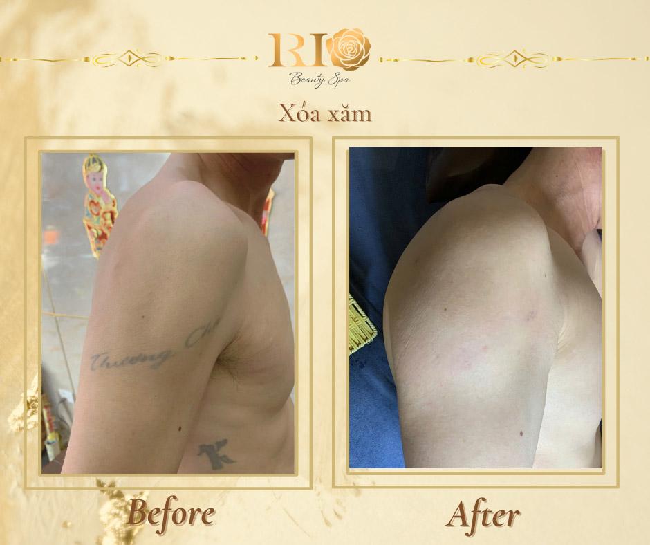 Xóa xăm uy tín: Những tiêu chí xóa xăm mới nhất 2025 6 Địa chỉ xóa hình xăm uy tín Thẩm Mỹ Rio xóa sạch hình xăm ở bắp tay