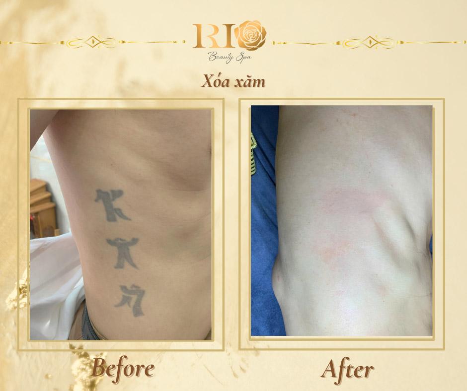 Xóa xăm uy tín: Những tiêu chí xóa xăm mới nhất 2025 7 Địa chỉ xoá hình xăm uy tín Thẩm Mỹ Rio Beauty Clinic với rất nhiều ca xóa hình xăm thành công vượt mong đợi
