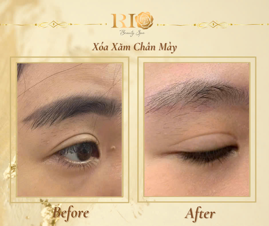 Xóa xăm lông mày bằng laser có nên hay không sự thật bạn cần biết 6 Thẩm Mỹ Rio xóa xăm lông mày bằng laser công nghệ cao đạt tiêu chuẩn FDA và ISO 13485 an toàn tuyệt đối