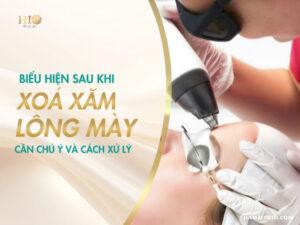 Biểu hiện sau khi xóa xăm lông mày