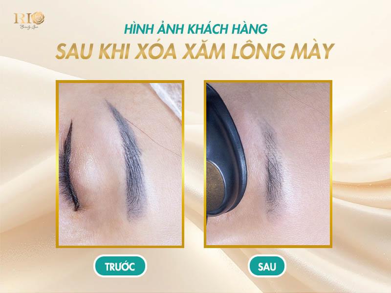 Hình ảnh sau khi xóa xăm bằng công nghệ Laser hiện đại 3 Hình ảnh sau khi xóa xăm lông mày tại Thẩm Mỹ Rio Beauty Clinic