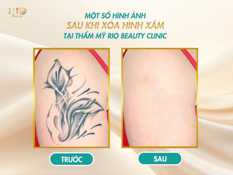 Hình ảnh sau khi xóa xăm bằng công nghệ Laser hiện đại 9 Hình ảnh sau khi xóa xăm bằng Laser tại Thẩm Mỹ Rio Beauty Clinic