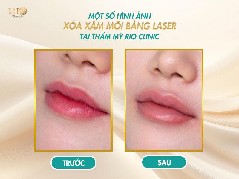 Hình ảnh sau khi xóa xăm bằng công nghệ Laser hiện đại 4 Hình ảnh sau khi xóa xăm môi tại Thẩm Mỹ Rio Beauty Clinic