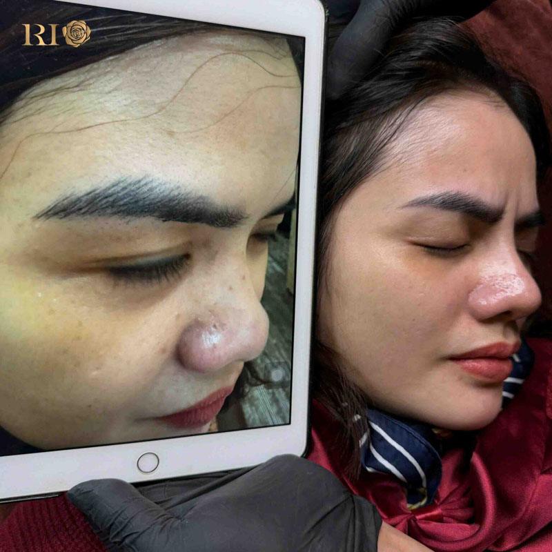 Hình ảnh sau khi xóa xăm bằng công nghệ Laser hiện đại 5 Hình ảnh sau khi xóa xăm mí mắt tại Thẩm Mỹ Rio Beauty Clinic