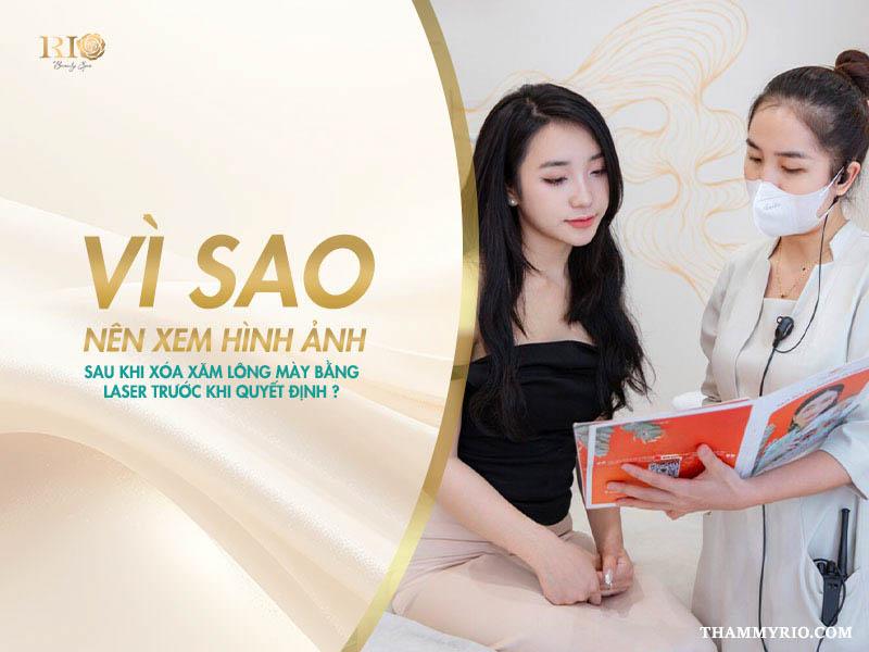 Trọn bộ hình ảnh sau khi xóa xăm lông mày bằng Laser 3 Việc tham khảo hình ảnh sau khi xóa xăm lông mày bằng Laser không chỉ giúp bạn hình dung kết quả mà còn mang lại nhiều lợi ích thực tế.