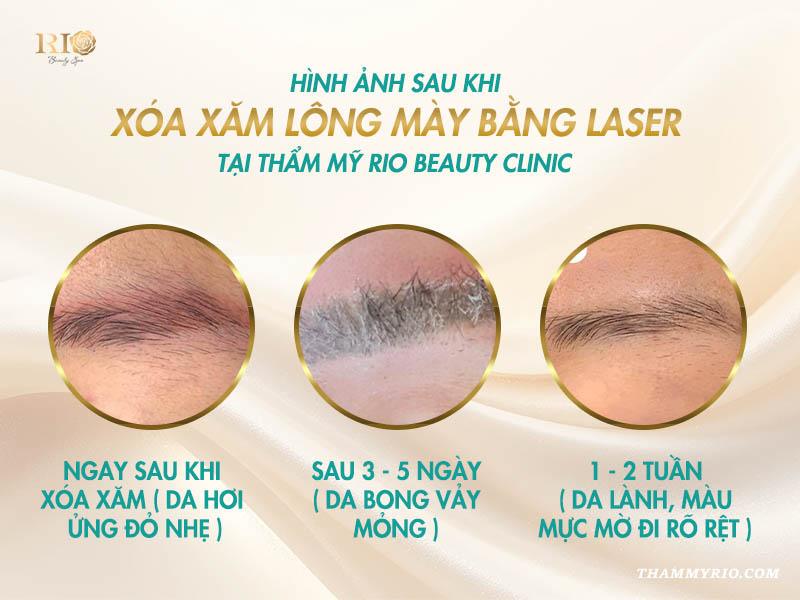 Trọn bộ hình ảnh sau khi xóa xăm lông mày bằng Laser 4 Chi tiết hình ảnh sau khi xóa xăm lông mày bằng Laser. Ngay sau khi xóa, da hơi đỏ nhẹ; sau 3–5 ngày bắt đầu bong mài mỏng và khoảng 1–2 tuần sau, màu mực mờ rõ, da đều màu.