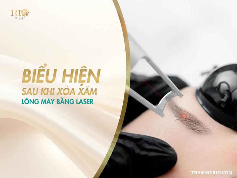 Trọn bộ hình ảnh sau khi xóa xăm lông mày bằng Laser 8 Hiểu rõ các phản ứng của da thông qua hình ảnh sau khi xóa xăm lông mày bằng Laser không chỉ giúp bạn có tâm lý vững vàng mà còn là yếu tố then chốt để chăm sóc và phục hồi tại nhà hiệu quả.