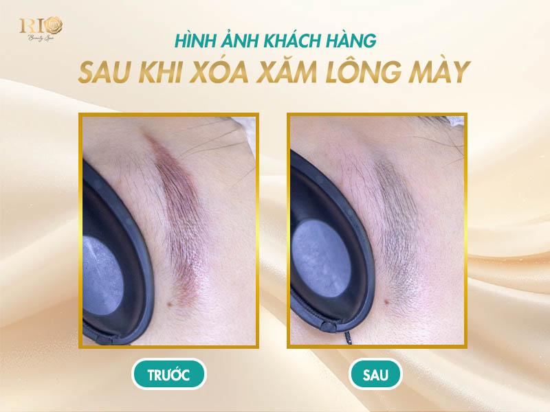 Trọn bộ hình ảnh sau khi xóa xăm lông mày bằng Laser 5 Hình ảnh sau khi xóa xăm lông mày bằng laser, màu mực mờ rõ, da đều màu.