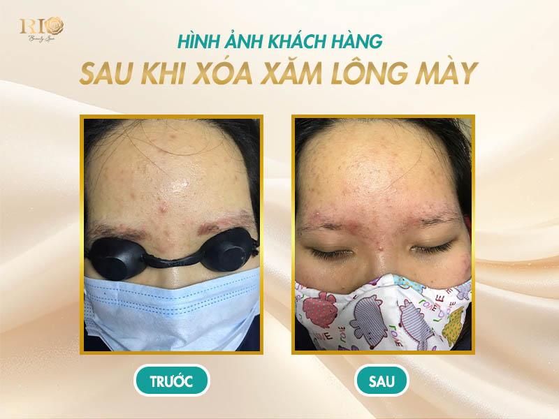 Trọn bộ hình ảnh sau khi xóa xăm lông mày bằng Laser 7 Kết quả - hình ảnh sau khi xóa xăm lông mày bằng laser, vùng da phục hồi và đều màu.