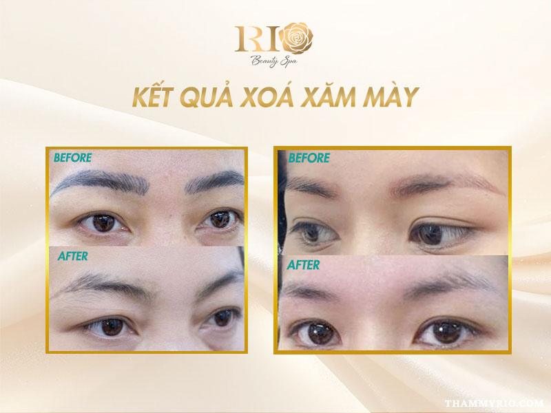 Phương pháp hút mực chân mày bằng dung dịch có an toàn không? 8 Kết quả phục hồi sau khi thay thế hút mực chân mày bằng dung dịch bằng công nghệ laser, da sáng và đều màu hơn.