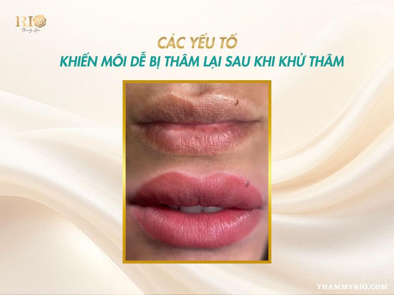 Khử thâm môi có bị thâm lại không? Nên khử thâm môi không? 3 Các yếu tố khiến khử thâm môi có bị thâm lại không