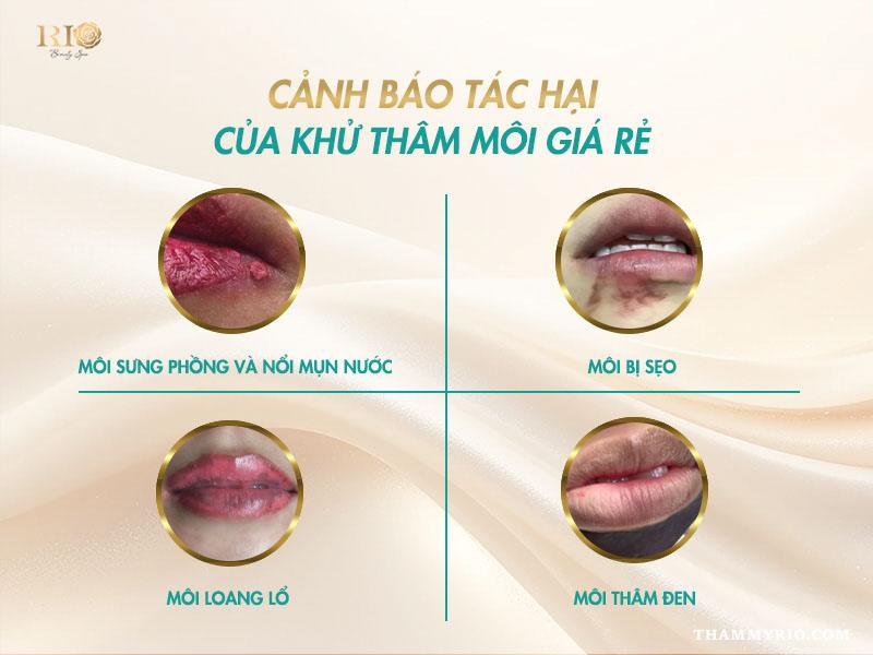 Khử thâm môi có bị thâm lại không? Nên khử thâm môi không? 5 Cảnh báo khử thâm môi có bị thâm lại không khi chọn dịch vụ giá rẻ