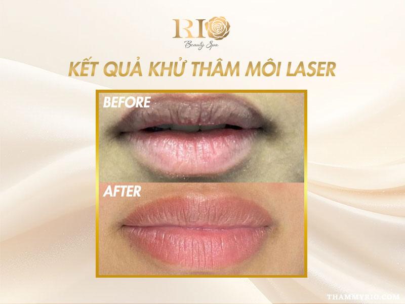Khử thâm môi giá bao nhiêu? Cập nhật bảng giá khử thâm môi mới 3 Hình ảnh trước và sau khi khử thâm môi giá bao nhiêu bằng công nghệ laser hiện đại.