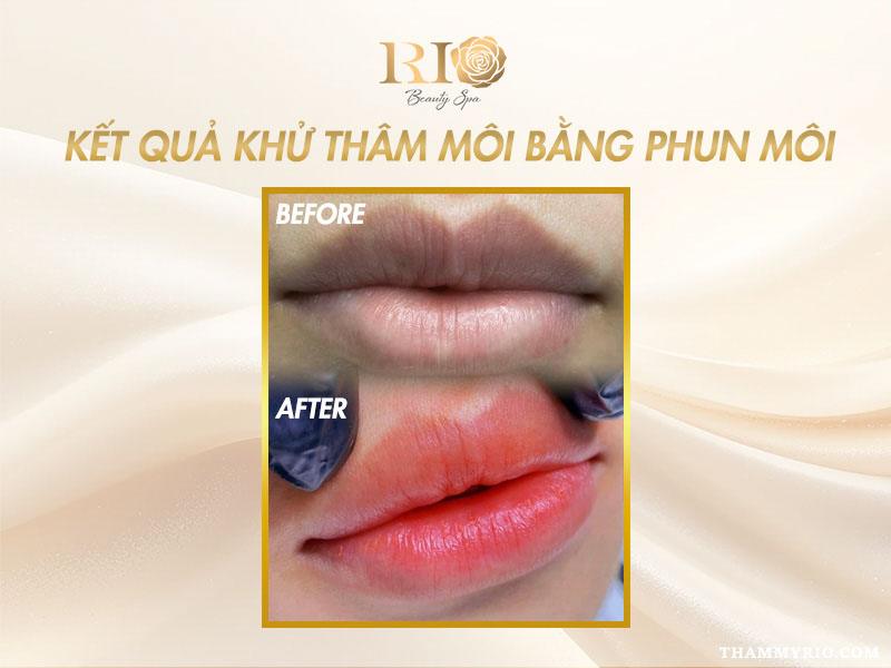 Khử thâm môi giá bao nhiêu? Cập nhật bảng giá khử thâm môi mới 4 Kết quả khử thâm môi giá bao nhiêu khi áp dụng phương pháp phun môi thẩm mỹ.