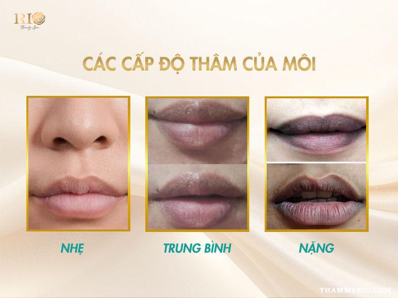 Khử thâm môi giá bao nhiêu? Cập nhật bảng giá khử thâm môi mới 6 Các cấp độ thâm môi và mức giá khử thâm môi giá bao nhiêu phụ thuộc tình trạng da.