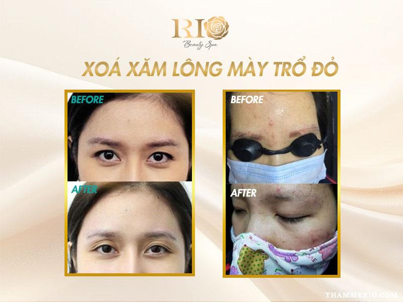 Lông mày trổ đỏ có xóa được không? Giải đáp chi tiết 6 ca xóa trổ đỏ thành công tại Rio Beauty Clinic – chân mày trở lại màu sắc tự nhiên, không để lại sẹo.