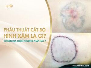 Phẫu thuật cắt bỏ hình xăm là gì? Có đau không?