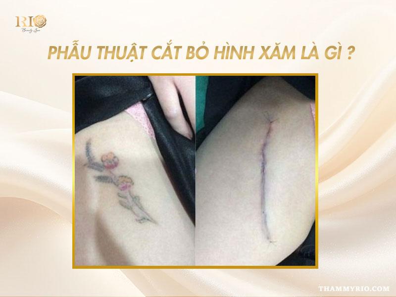Phẫu thuật cắt bỏ hình xăm là gì? Có nên lựa chọn phương pháp này? 2 Minh họa thông tin về phẫu thuật cắt bỏ hình xăm và khái niệm cơ bản của phương pháp này.