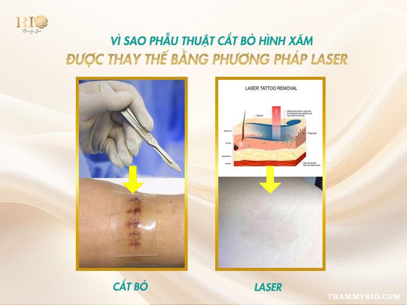 Phẫu thuật cắt bỏ hình xăm là gì? Có nên lựa chọn phương pháp này? 5 So sánh cơ chế và kết quả giữa phẫu thuật cắt bỏ hình xăm và xóa xăm bằng laser.