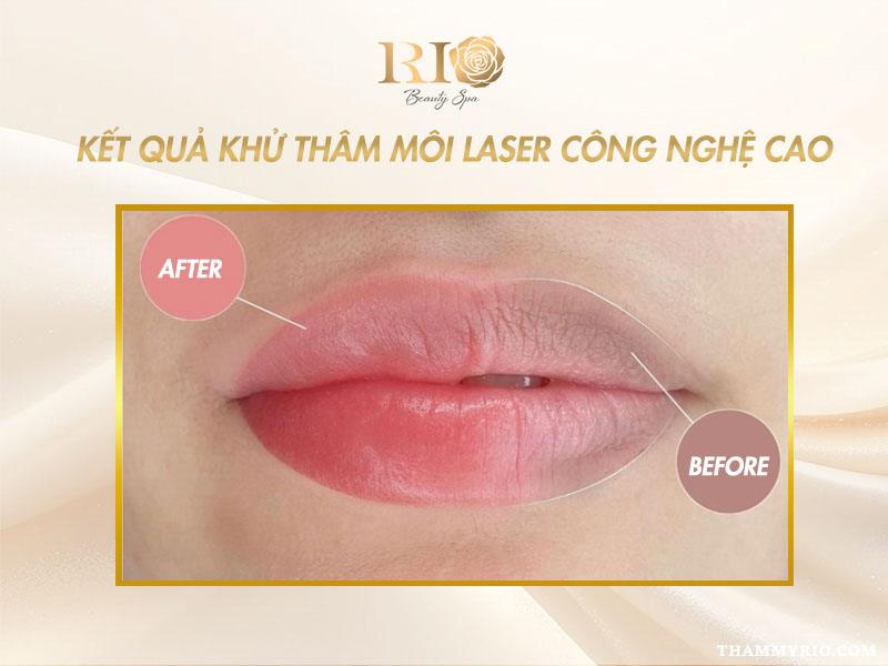 Quy trình khử thâm môi gồm những bước nào và có đau không? 4 Kết quả quy trình khử thâm môi Laser công nghệ cao