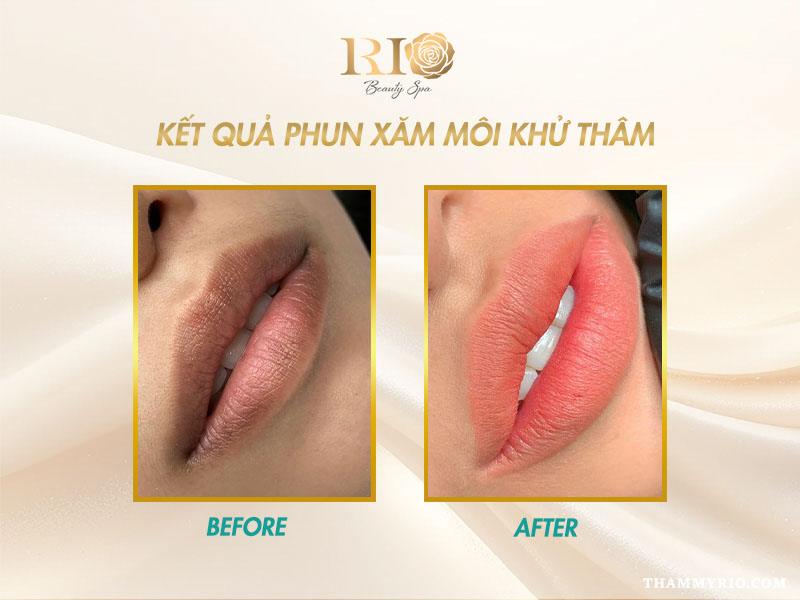 Quy trình khử thâm môi gồm những bước nào và có đau không? 5 Kết quả quy trình khử thâm môi bằng phun xăm thẩm mỹ