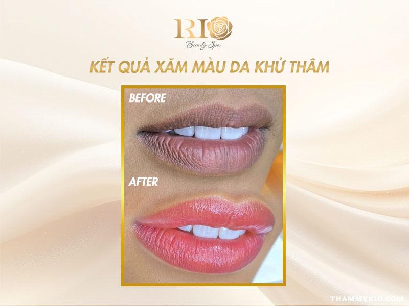 Quy trình khử thâm môi gồm những bước nào và có đau không? 6 Kết quả quy trình khử thâm môi bằng xăm màu hồng phấn