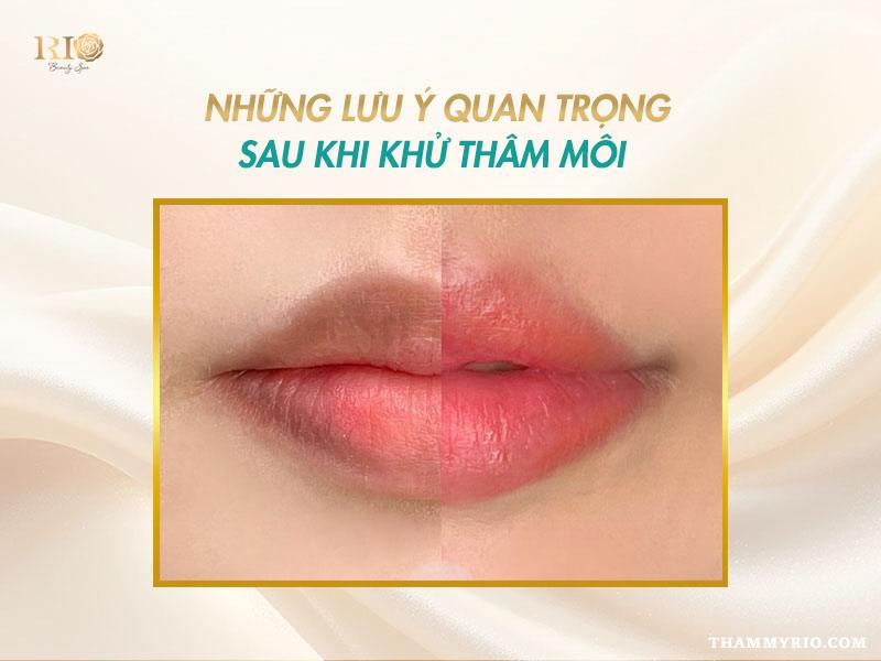 Quy trình khử thâm môi gồm những bước nào và có đau không? 7 Lưu ý quan trọng sau quy trình khử thâm môi