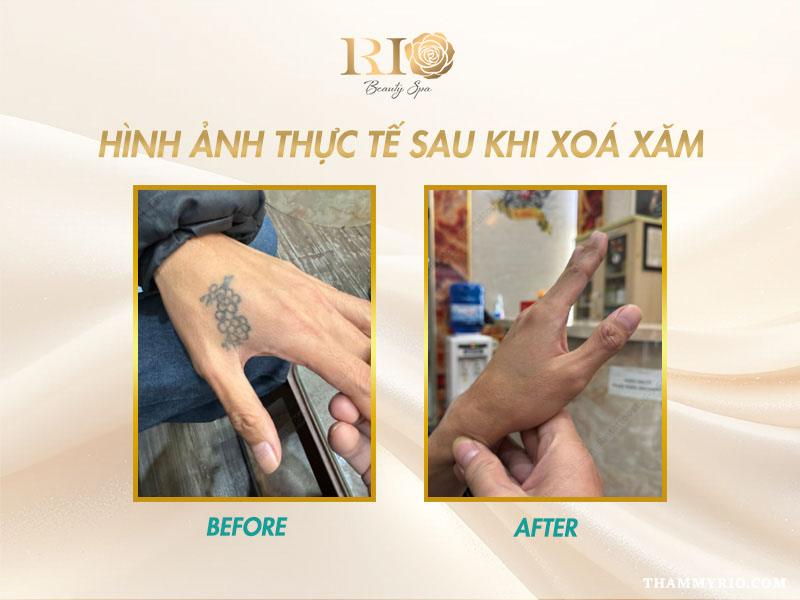 Nỗi lo sẹo xóa xăm - Xóa xăm bằng laser có để lại sẹo không? 8 Hình ảnh sau khi xóa hình xăm lớn ở bắp tay, không còn dấu tích mực xăm, da phục hồi đều màu và không sẹo xóa xăm.