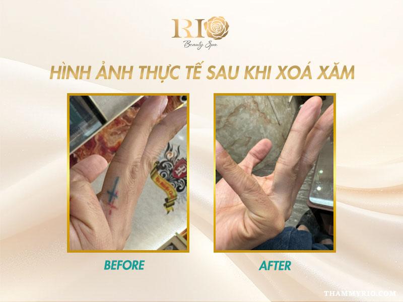 Nỗi lo sẹo xóa xăm - Xóa xăm bằng laser có để lại sẹo không? 9 Hình ảnh sau khi xóa hình xăm lớn ở bắp tay, không còn dấu tích mực xăm, da phục hồi đều màu và không sẹo xóa xăm.