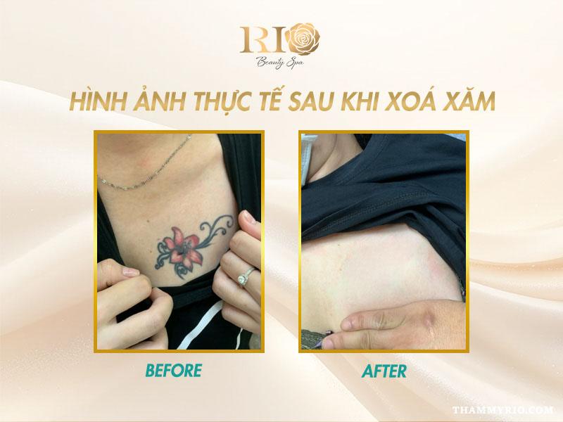 Nỗi lo sẹo xóa xăm - Xóa xăm bằng laser có để lại sẹo không? 10 Hình ảnh sau khi xóa hình xăm lớn ở bắp tay, không còn dấu tích mực xăm, da phục hồi đều màu và không sẹo xóa xăm.
