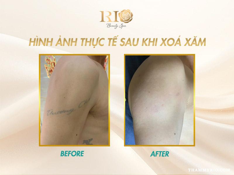 Nỗi lo sẹo xóa xăm - Xóa xăm bằng laser có để lại sẹo không? 11 Hình ảnh sau khi xóa hình xăm lớn ở bắp tay, không còn dấu tích mực xăm, da phục hồi đều màu và không sẹo xóa xăm.