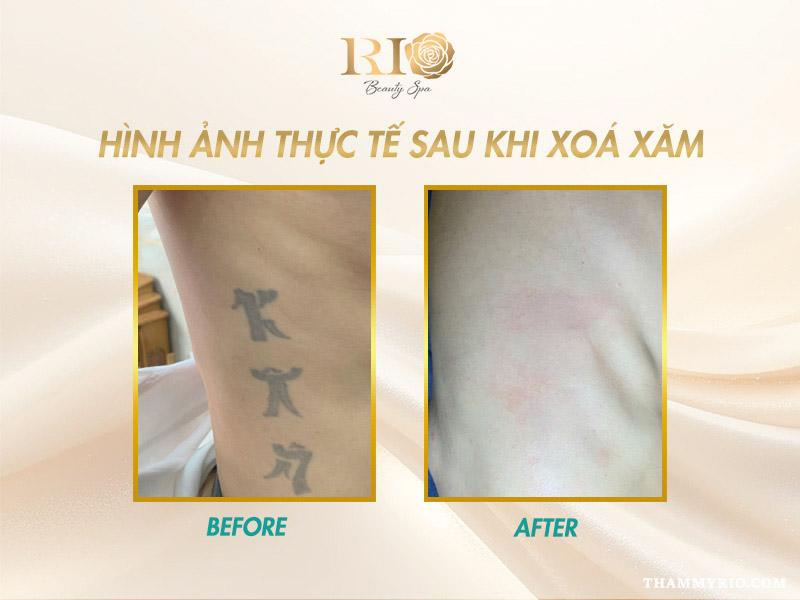 Nỗi lo sẹo xóa xăm - Xóa xăm bằng laser có để lại sẹo không? 12 Hình ảnh vùng da sau khi xóa xăm không để lại sẹo xóa xăm, da đều màu và tự nhiên.