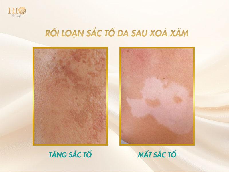 Nỗi lo sẹo xóa xăm - Xóa xăm bằng laser có để lại sẹo không? 3 Hình ảnh phân biệt rõ ràng giữa sẹo xóa xăm do tăng sắc tố và mất sắc tố sau khi điều trị bằng laser.