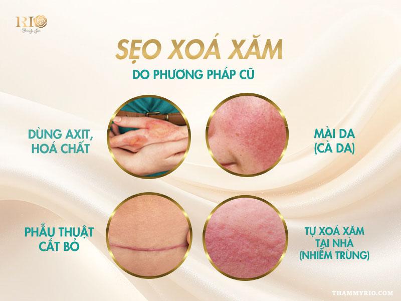 Nỗi lo sẹo xóa xăm - Xóa xăm bằng laser có để lại sẹo không? 4 Hình ảnh mô tả sẹo xóa xăm nghiêm trọng do các phương pháp truyền thống như cắt, mài, đốt điện.