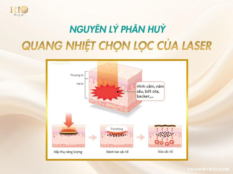 Nỗi lo sẹo xóa xăm - Xóa xăm bằng laser có để lại sẹo không? 6 Nguyên lý xóa xăm bằng công nghệ laser hiện đại giúp phá vỡ mực xăm mà không làm tổn thương da, hạn chế sẹo xóa xăm.