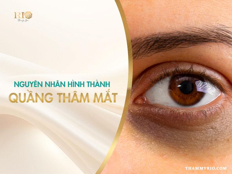 Top giải pháp xóa quầng thâm mắt vĩnh viễn an toàn, hiệu quả 2 Nguyên nhân gây quầng thâm mắt do di truyền, thiếu ngủ và lão hóa da
