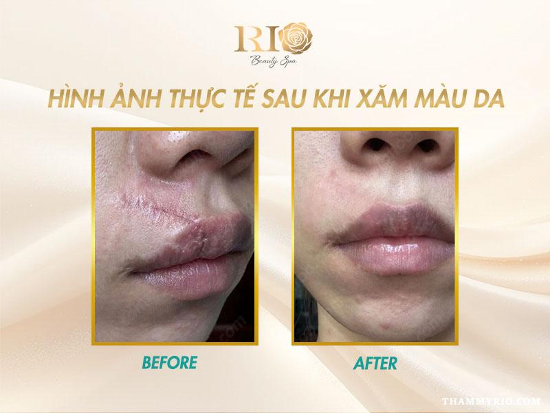 Xóa xăm 1 lần là gì? Hiệu quả xóa hình xăm 1 lần sạch tới 95% 6 ết quả xăm màu da sau xóa xăm 1 lần, giúp che phủ và làm đều màu da.
