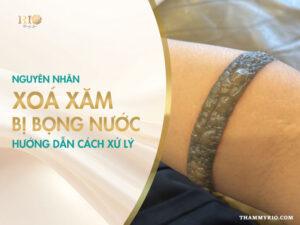 Nguyên nhân xóa xăm bị bọng nước và ướng dẫn cách xử lý.