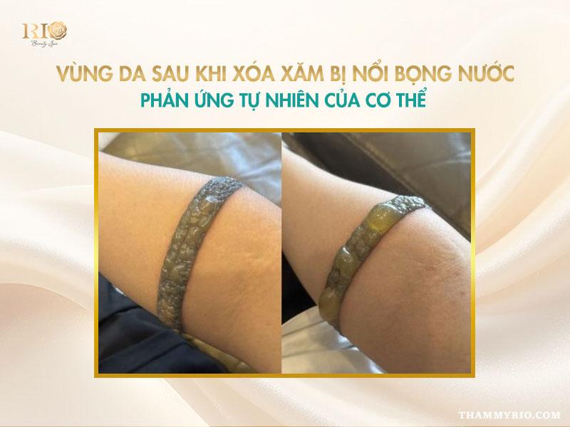 Nguyên nhân xóa xăm bị bọng nước và hướng dẫn cách xử lý 2 Vùng da sau khi xóa xăm bị bọng nước – phản ứng phục hồi tự nhiên của cơ thể