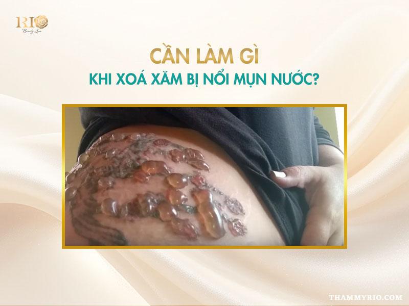 Nguyên nhân xóa xăm bị bọng nước và hướng dẫn cách xử lý 4 Chuyên gia tư vấn cách xử lý khi xóa xăm bị bọng nước để đảm bảo an toàn cho da