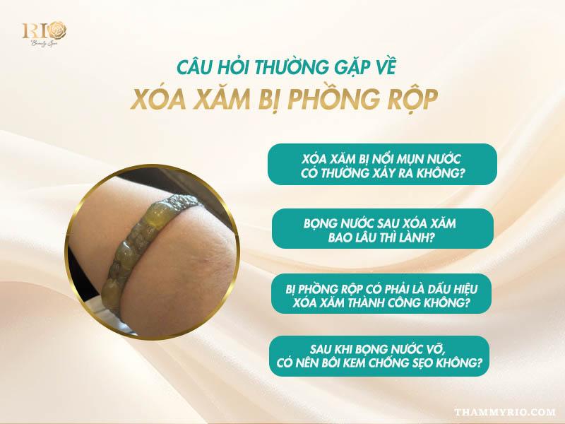 Nguyên nhân xóa xăm bị bọng nước và hướng dẫn cách xử lý 7 Giải đáp thắc mắc thường gặp về hiện tượng xóa xăm bị bọng nước và phồng rộp