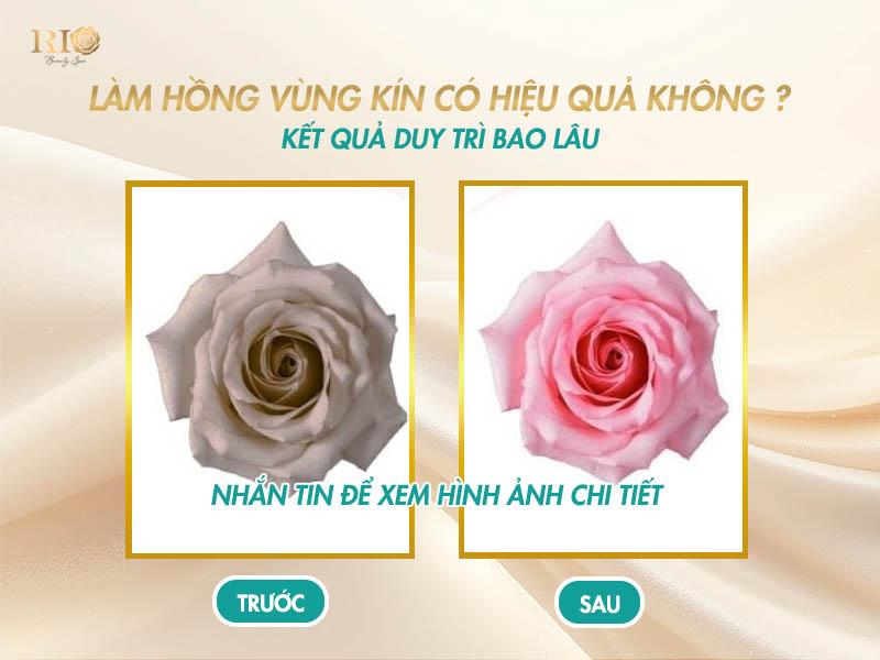 Có nên làm hồng vùng kín không? - Giải đáp từ A - Z 5 Làm hồng vùng kín có hiệu quả không?