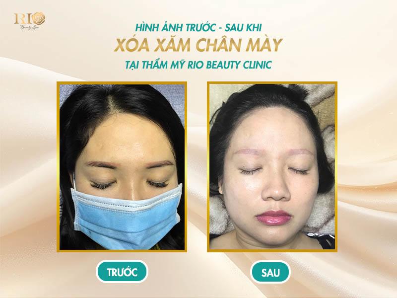 Hình ảnh khách hàng trải nghiệm xóa xăm lông mày tại Thẩm Mỹ Rio Beauty Clinic