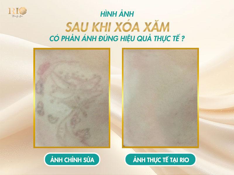 Hình ảnh sau khi xóa xăm bằng công nghệ Laser hiện đại 2 Trên Internet tràn ngập hình ảnh sau khi xóa xăm, tuy nhiên, không phải tất cả đều đáng tin. Việc trang bị cho mình kiến thức để "giải mã" những hình ảnh này sẽ biến bạn thành một người tiêu dùng thông thái.