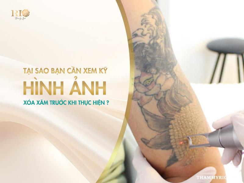 Hình ảnh sau khi xóa xăm bằng công nghệ Laser hiện đại 17 Tham khảo hình ảnh sau khi xóa xăm thực tế tại các cơ sở uy tín là một bước không thể thiếu.