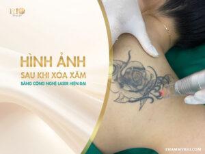 Xem thư viện hình ảnh sau khi xóa xăm bằng laser không sẹo. So sánh chi tiết công nghệ hiện đại với phương pháp cũ để đưa ra lựa chọn xóa xăm an toàn nhất.