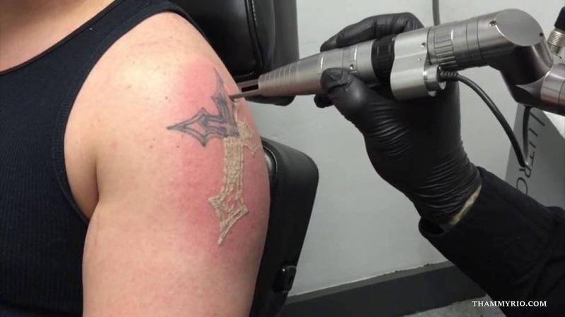 Hình ảnh sau khi xóa xăm bằng công nghệ Laser hiện đại 14 Hình ảnh sau khi xóa xăm bằng laser ngày đầu, da ửng đỏ nhẹ