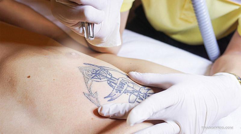 Hình ảnh sau khi xóa xăm bằng công nghệ Laser hiện đại 10 Hình ảnh xóa hình xăm chữ và họa tiết bằng công nghệ Laser tại Thẩm Mỹ Rio