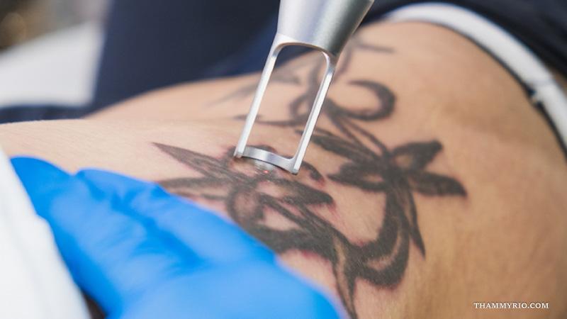 Hình ảnh sau khi xóa xăm bằng công nghệ Laser hiện đại 8 Xóa hình xăm nghệ thuật bằng công nghệ Laser an toàn